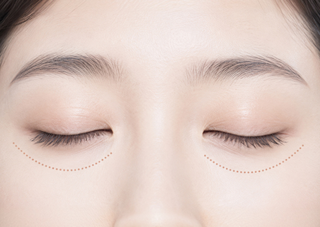 유지 기간이 긴 수술 노하우
