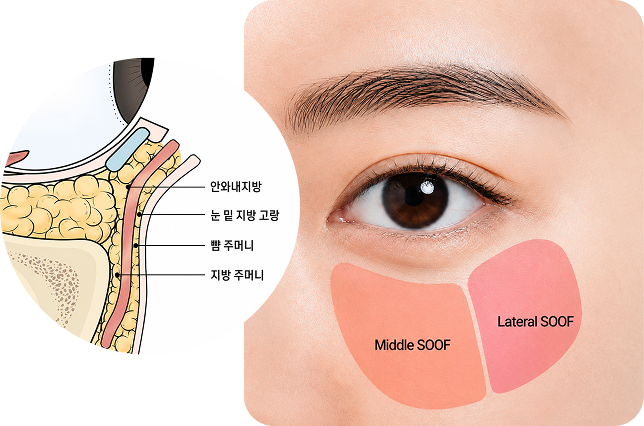 안면 신경 손상 없이 수술