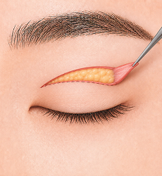 상안검 STEP 2