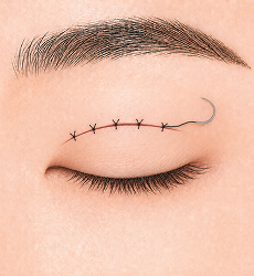 상안검 STEP 3