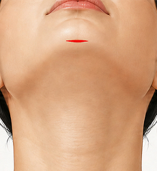 이중턱성형술 STEP 1