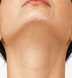 이중턱성형술 STEP 4