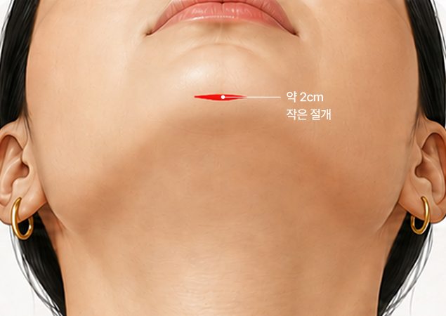 작은 절개로 흉터 부담 최소화