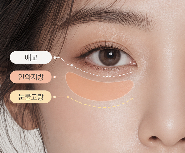 눈밑 지방 재배치 사진