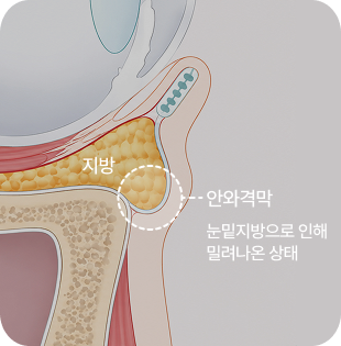 안와격막 강화로 유지력을 높이는 기술력