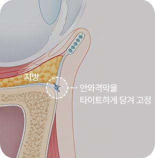 안와격막 강화로 유지력을 높이는 기술력