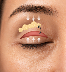 눈 위 지방 재배치 STEP 2