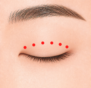 자연유착 STEP 2