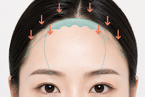 원앤온리 내시경 이마거상 STEP 2