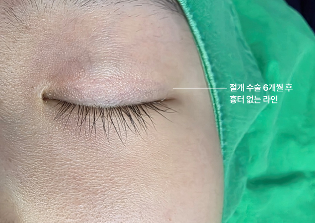 절개 수술 6개월 후 흉터 없는 라인