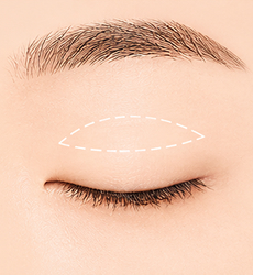 절개 STEP 2