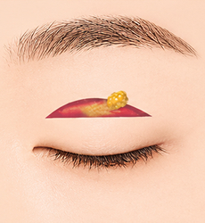 절개 STEP 3