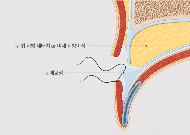 꺼진 눈 교정