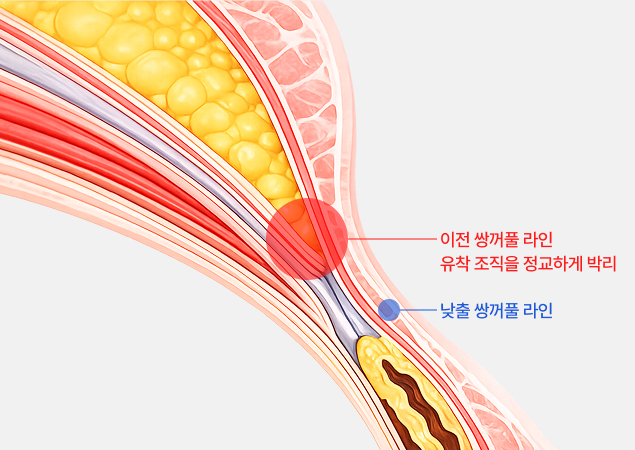 유착 박리 기술력