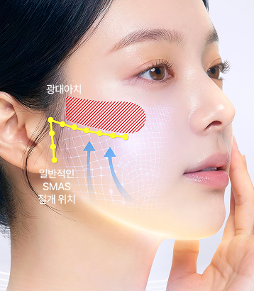 일반적인 SMAS 절개