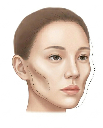 땅콩형